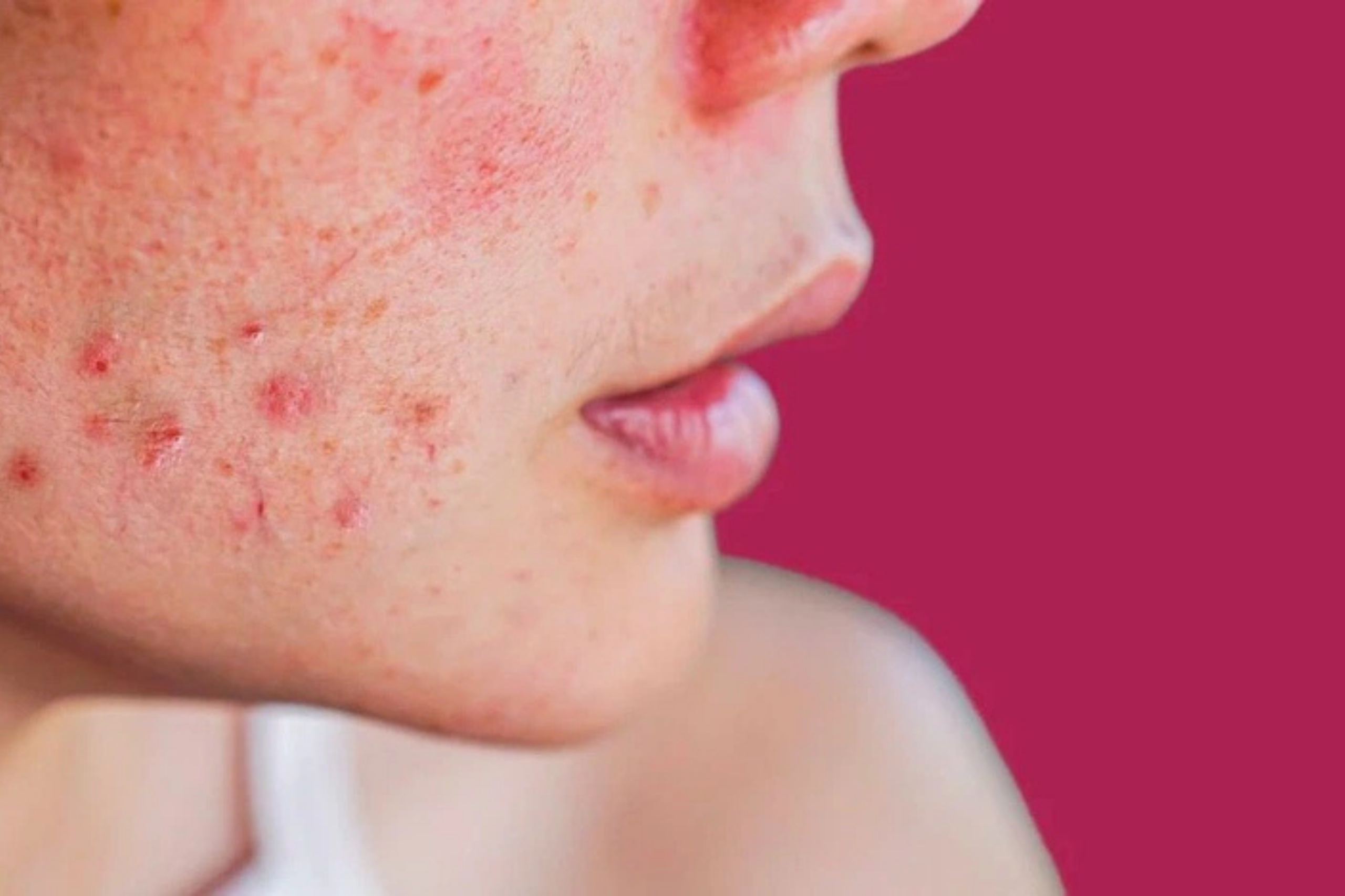 Da nhạy cảm bị kích ưng đỏ